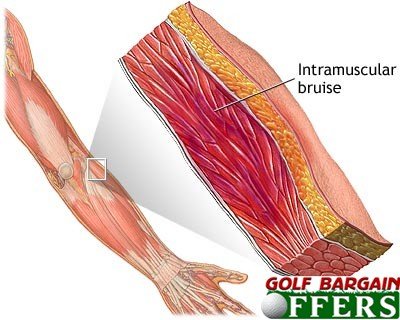 Muscle Injury